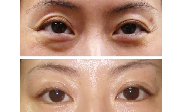 魚(yú)尾紋是怎么引起的？