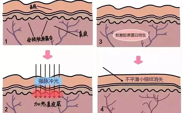 光子嫩膚去魚尾紋