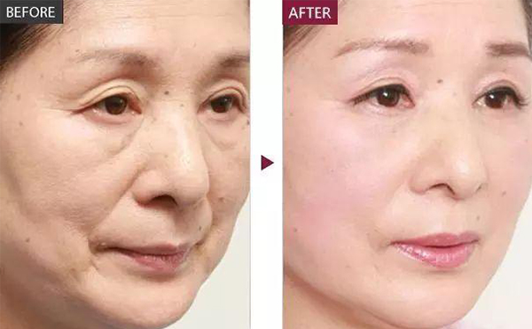 膠原蛋白除皺的適應(yīng)人群？