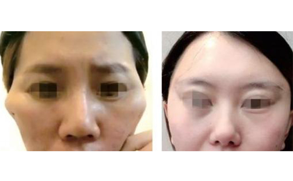 筋膜懸吊除皺有什么副作用？