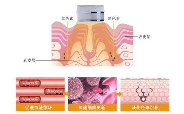 光子嫩膚效果好不好？