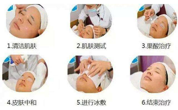 果酸煥膚的過程是什么？