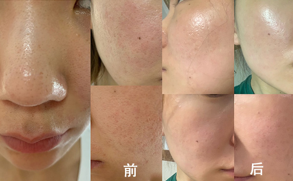 無針水光有什么優(yōu)勢？