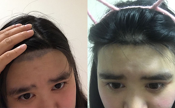 激光脫毛安全嗎？