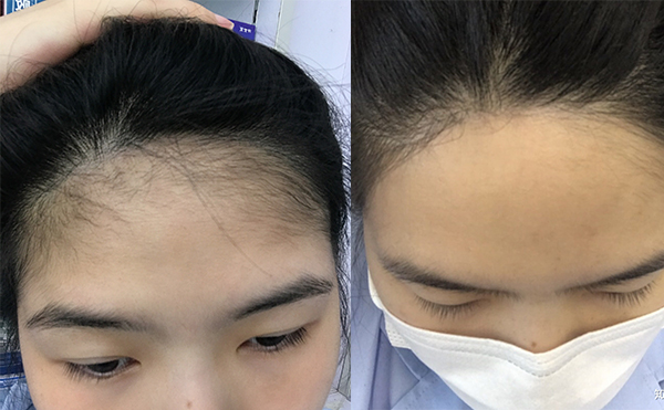 激光脫發(fā)際線的過程是什么？