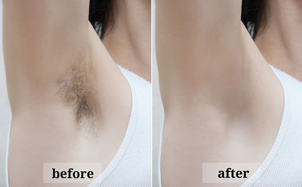 激光脫腋毛效果怎么樣？