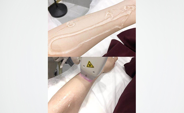 激光手臂脫毛是怎么做的？