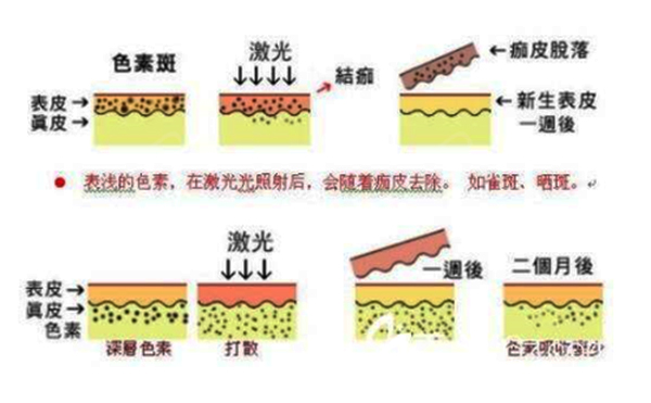 光子嫩膚和皮秒有什么區(qū)別？
