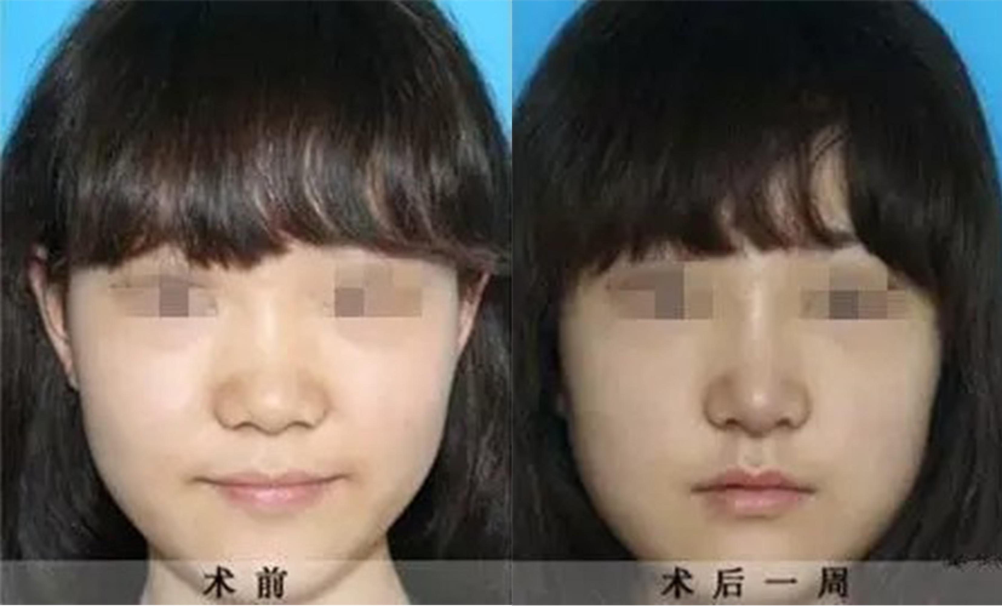 鼻頭、鼻翼縮小