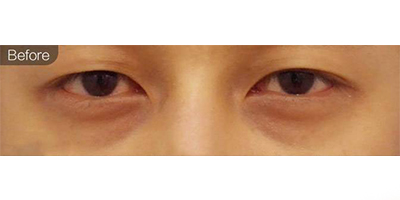 膠原蛋白去黑眼圈術(shù)前