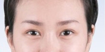 上眼瞼去脂術后
