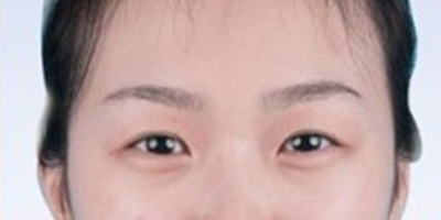 上眼瞼去脂術前