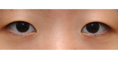 開內(nèi)眼角術(shù)前