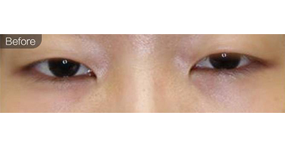 上瞼提肌術(shù)前