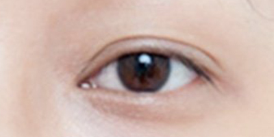 玻尿酸豐眼窩術(shù)后