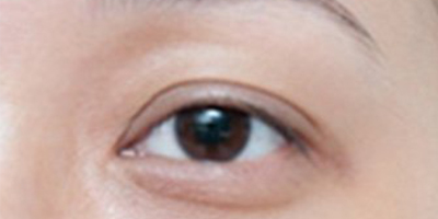 玻尿酸豐眼窩術(shù)前