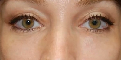 熊貓針去黑眼圈術(shù)后