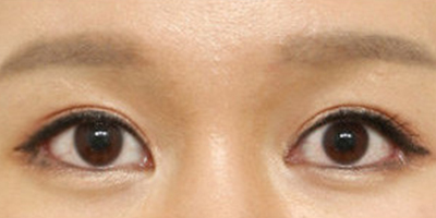 開外眼角術(shù)后