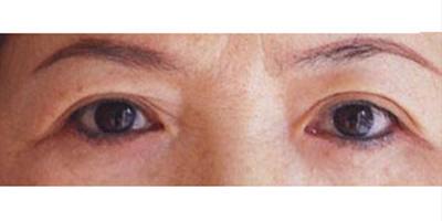 切眉術(shù)術(shù)后