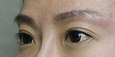 玻尿酸豐眉弓術(shù)后