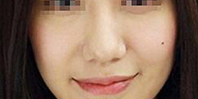 膠原蛋白填充蘋果肌術(shù)后