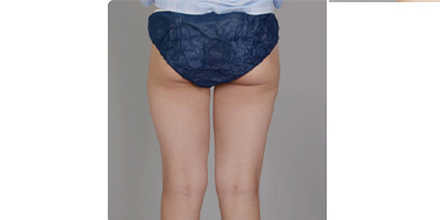 超聲溶脂瘦臀部術(shù)前