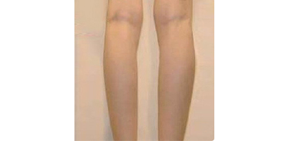 射頻溶脂瘦小腿術(shù)后