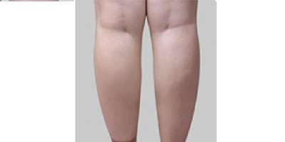 隔空溶脂瘦小腿術(shù)前