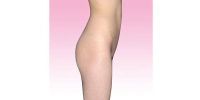 自體脂肪豐臀術前