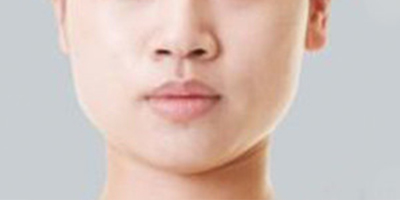 下頜角整形術前