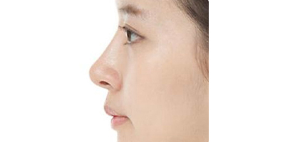 假體墊鼻基底術(shù)后