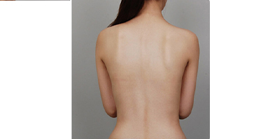 動(dòng)氧瘦腰部術(shù)后