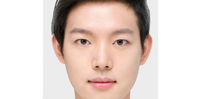 歪鼻矯正術(shù)后