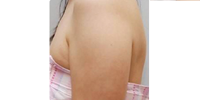 隔空溶脂瘦手臂術(shù)前