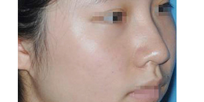 玻尿酸豐鼻基底術前