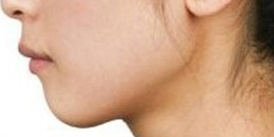 玻尿酸墊下巴術(shù)前