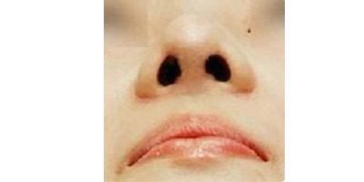 鼻部硅膠假體取出術后