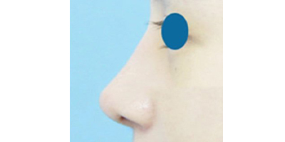 自體軟骨墊鼻基底術(shù)后