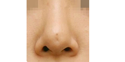 鼻部修復(fù)術(shù)前