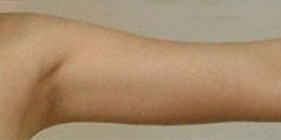 手臂吸脂術(shù)后