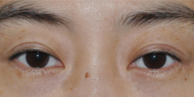 眼部修復(fù)術(shù)前