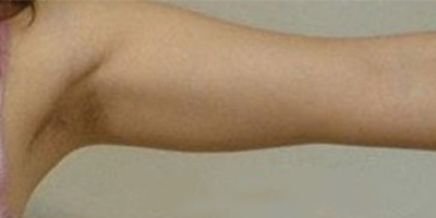 手臂吸脂術(shù)前