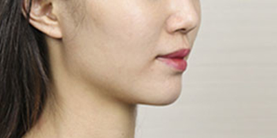 玻尿酸豐蘋果肌術(shù)后