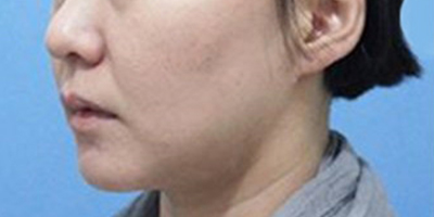 埋線提升術(shù)前