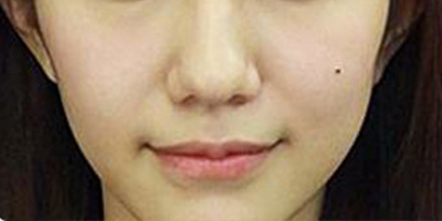 膠原蛋白填充蘋果肌術(shù)前