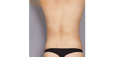 優(yōu)立塑術(shù)后