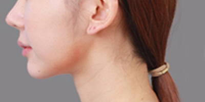 硅膠墊下巴術(shù)后