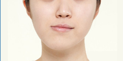 面部不對(duì)稱矯正術(shù)前