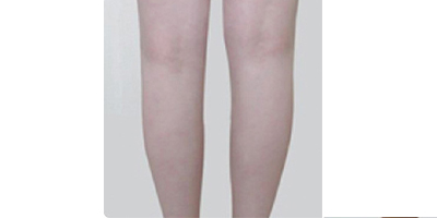 隔空溶脂瘦小腿術(shù)后