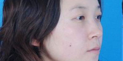 曼特波隆鼻術(shù)前